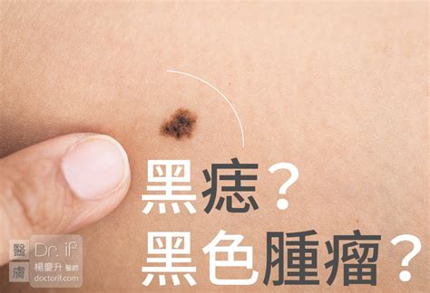 不規則黑痣|不大驚小怪！如何辨別「黑痣」與「黑色腫瘤」？ 